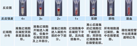 【試驗?zāi)康暮驮怼? ABO血型鑒定是通過檢測被檢者紅細(xì)胞上是否存在A和/或B抗原（正定型）以及被檢者血漿中是否存在抗A和/或抗B抗體（反定型）來確定。 對于成年個體被檢者，紅細(xì)胞上的A和/或B抗原與血漿中的抗A和/或抗B抗體存在一種對應(yīng)關(guān)系。其獨特性質(zhì)在于：紅細(xì)胞上缺乏A和/或B抗原，則血清中存在與所缺乏的抗原對應(yīng)的強(qiáng)反應(yīng)性抗體，如紅細(xì)胞上缺乏A抗原，則可以預(yù)見血漿中存在抗A抗體。 常規(guī)的ABO定型必須包括正定型（紅細(xì)胞定型）和反定型（血漿定型），并將正反定型結(jié)果相互驗證，如果紅細(xì)胞發(fā)生凝集，預(yù)期其凝集強(qiáng)度≥2+；只有正反定型結(jié)果一致時才能準(zhǔn)確定型。 20121212104627668.jpg  然而，有時ABO正定型和反定型會出現(xiàn)結(jié)果不一致現(xiàn)象，或陽性反應(yīng)強(qiáng)度弱于2+。引起正反定型結(jié)果不一致因素有： （一）正定型出現(xiàn)弱反應(yīng)或缺失抗原 1. A亞型、B亞型或AB亞型。 2. 白血病導(dǎo)致A或B抗原減弱。 3. 何杰金?。℉odgkin’s）有時會抑制抗原表達(dá)，與白血病類似。 4. 由于某種疾?。ㄈ绺骨话⒁认侔?dǎo)致血漿中存在大量的型物質(zhì)，中和抗A或抗B抗體，引起正定型為假陰性或弱陽性。需要將正定型的紅細(xì)胞用生理鹽水洗滌后再次定型可解決此問題。 5. 骨髓移植 6. 非ABO同型輸血 （二）正定型紅細(xì)胞上多余的抗原反應(yīng) 1. 自身凝集紅細(xì)胞、抗體致敏紅細(xì)胞導(dǎo)致。 2. 細(xì)胞未洗滌，血漿蛋白引起的假陽性反應(yīng)。 3. 細(xì)胞未洗滌，血漿中存在針對正定型試劑中某種成分的抗體導(dǎo)致。 4. 骨髓移植。 5. 獲得性B。 6. B（A）現(xiàn)象。 7. ABO非相合輸注。 （三）正定型出現(xiàn)混合視野反應(yīng) 1. 近期輸血。 2. 骨髓移植。 3. 異卵雙胞胎或雙受精卵產(chǎn)生的嵌合體。 4. 胎兒和母體出血。 5. A3亞型。 （四）反定型血清中出現(xiàn)弱反應(yīng)或反應(yīng)缺失 1. 年齡相關(guān)：新生兒以及小于6月齡的嬰兒以及老年人。 2. ABO亞型有亞型抗體，如A2、A2B型人的抗A1。 3. 低球蛋白血癥（如白血病人、使用免疫抑制劑患者、免疫缺陷患者）。 4. 移植患者使用抗排異藥物。 5. 雙胞胎或雙受精卵產(chǎn)生的嵌合體。 （五）反定型出現(xiàn)多余的抗體反應(yīng) 1. 冷自身抗體。 2. 特異性冷同種抗體。 3. 血清中存在針對試劑紅細(xì)胞保存液成分的抗體。 4. 某些疾病導(dǎo)致球蛋白水平增高（多發(fā)性骨髓瘤、巨球蛋白血癥、Hodgkin’s 淋巴瘤）引起緡錢狀凝集。 5. 輸用大分子血漿擴(kuò)容劑。 6. 非ABO同型的移植。 7. 靜脈注射免疫球蛋白。 （六）技術(shù)方面的錯誤 1. 血液樣本被污染，如混入其他人樣本。 2. 被檢紅細(xì)胞的濃度過高或過低。 3. 忘記在反應(yīng)體系中加入檢測樣本或試劑。 4. 未按照試劑使用說明進(jìn)行試驗。 5. 離心步驟離心時間不足或離心時間超時。 6. 對試驗結(jié)果記錄或判讀不正確。 為了解決ABO亞型引起的ABO正反定型不一致以及正定型紅細(xì)胞上抗原產(chǎn)生弱反應(yīng)或抗原反應(yīng)性缺失，可以使用ABO亞型定型卡來輔助血型鑒定。 ABO亞型定型卡系采用凝膠作為微柱凝膠卡的填充物，將生物化學(xué)的凝膠分子篩過濾技術(shù)、離心技術(shù)和血型血清學(xué)的抗體特異性結(jié)合在一起。每卡有八個凝膠管，其中抗A凝膠管灌注了含抗A抗體的凝膠；抗A1凝膠管灌注了含抗A1抗 體的凝膠；抗B凝膠管灌注了含抗B抗體的凝膠；抗AB凝膠管灌注了含抗AB抗體的凝膠；抗H凝膠管灌注了含抗H抗體的凝膠；A細(xì)胞、B細(xì)胞及Ctl管中灌 注了不含血型抗體的凝膠，A細(xì)胞、B細(xì)胞用于檢測血漿中的抗體，Ctl管用于自身對照。當(dāng)抗原抗體反應(yīng)時，凝集的紅細(xì)胞在離心力的作用下不能通過凝膠而留 在凝膠上層或游離在凝膠中，呈現(xiàn)陽性反應(yīng)；而抗原抗體沒有反應(yīng)時，未凝集的紅細(xì)胞在離心力的作用下可通過凝膠而沉積在微柱凝膠管的底部，呈現(xiàn)陰性反應(yīng)。 【ABO亞型定型卡的用途】 鑒定紅細(xì)胞上的ABO抗原，解決亞型引起ABO正反定型不一致、以及正定型紅細(xì)胞上抗原產(chǎn)生弱反應(yīng)或抗原反應(yīng)性缺失的問題。 【樣本要求】 1. 建議使用抗凝的血樣，尤其是EDTA抗凝管采集的血樣，需要量2ml。（EDTA抗凝采血管為紫帽管）。 2. 血液樣本在采集后48小時以內(nèi)檢測。 【所需儀器設(shè)備及耗材】 1. ABO亞型定型卡 2. 血型血清學(xué)離心機(jī)（用于離心分離血漿、洗滌紅細(xì)胞） 3. 微柱凝膠卡離心機(jī) 4. 微量移液槍及吸頭 【試驗操作】  一、被檢血液樣本的處理 1. EDTA抗凝的血液樣本離心3000rpm 1分鐘，將上清血漿轉(zhuǎn)入一支12×75mm試管中備用，得到壓積紅細(xì)胞。 2. 另取一支12×75mm試管中，加入0.1ml上述步驟1中的壓積紅細(xì)胞 ，用生理鹽水洗滌一次，棄上清，得到壓積紅細(xì)胞。 3. 在一支12×75mm 試管中，加入1ml生理鹽水（或LISS液），加入步驟2中得到的壓積紅細(xì)胞10μl，混勻得到0.8~1%的被檢紅細(xì)胞懸液。 二、 紅細(xì)胞定型 1. 取ABO亞型定型卡一片，注意檢查外觀，確保凝膠管的凝膠上層存在液面，凝膠不會干枯。將符合要求的卡進(jìn)行標(biāo)記，按照試驗需要撕開封口膜。 2. 用微量移液槍分別向每孔樣品槽中沿樣品槽內(nèi)壁呈45°角緩慢加入50μl 0.8~1%的被檢者紅細(xì)胞懸液。 3. 在臺面交替輕叩卡左下角和右下角，確保所加入的液體在卡的樣品槽中呈水平狀態(tài)，而不是偏向一側(cè)。 4. 將卡放入微柱凝膠卡離心機(jī)離心，LB-3000低速離心機(jī)第一檔離心900rpm 2分鐘，再1500rpm 3分鐘，判讀結(jié)果并記錄。 【結(jié)果判讀及解釋】 1. 反應(yīng)陰、陽性的判讀 20121212104658937.jpg 2. 陰陽性結(jié)果解釋 (1) 陽性結(jié)果：紅細(xì)胞浮在凝膠表面或膠中，為陽性反應(yīng)。 (2) 陰性結(jié)果：紅細(xì)胞全部沉于微柱凝膠的底部。 (3) 血型亞型鑒定需要根據(jù)正反定型結(jié)果來判定，結(jié)果判定可參考下表。 20121212104720212.jpg 注：mf=混合視野，w=弱反應(yīng)。 【注意事項】 1. 建議在使用凝膠卡前先離心再應(yīng)用。 2. 若凝膠卡封口開裂、孔中凝膠干涸或有氣泡，不可使用。 3. 撕開凝膠卡封口膜時，不能用力過猛，以免造成凝膠微孔間的交叉污染。 4. 樣本采集后應(yīng)盡快檢測，若試驗需要延遲，應(yīng)將樣本置2~8℃下短期儲存。 5. 紅細(xì)胞懸液的濃度為0.8~1%，濃度過高或過低會影響檢測結(jié)果。 6. 溶血、脂血、細(xì)菌污染等情況的標(biāo)本會影響檢測結(jié)果。 7. 血漿或血清標(biāo)本須充分離心去除纖維蛋白，否則會阻止紅細(xì)胞在微柱凝膠中的沉降，出現(xiàn)假陽性。 8. 在Ctl孔（自身陰性對照）結(jié)果為陽性時，試驗結(jié)果無效?？赡茉蚴怯捎诒粰z紅細(xì)胞已經(jīng)致敏IgM抗體導(dǎo)致自發(fā)凝集，此時可以用DTT將已經(jīng)致敏到紅細(xì)胞上的IgM抗體破壞后再行試驗。 9. 人源血液樣本存在潛在的傳染性，凝膠卡使用后按醫(yī)療生物垃圾處理。